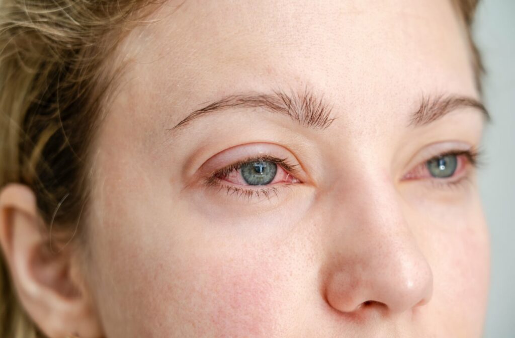 eyelid gland support blepharitis management